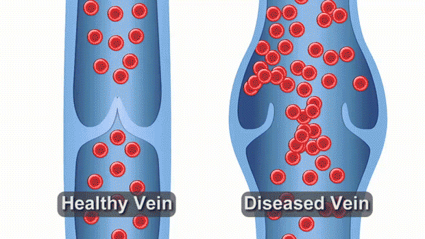 An animation comparing blood flow in a healthy deep vein versus a diseased deep vein. In the healthy vein, blood pulses upward efficiently. In the diseased vein, blood slows, pools, and flows backward due to damaged valves.