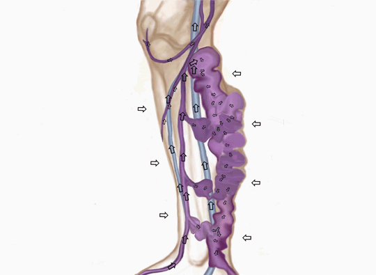 An animation of a bulging varicose vein being squeezed by external pressure. As the vein narrows, the valves begin to close properly, and the blood flow changes from pooling/backflow to a steady upward stream.