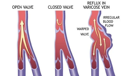 Three-part diagram of a leg vein: the first shows an open valve with blood flowing upward; the second shows a closed healthy valve preventing backflow; the third shows an incompetent valve where blood leaks backward, causing the vein to bulge.