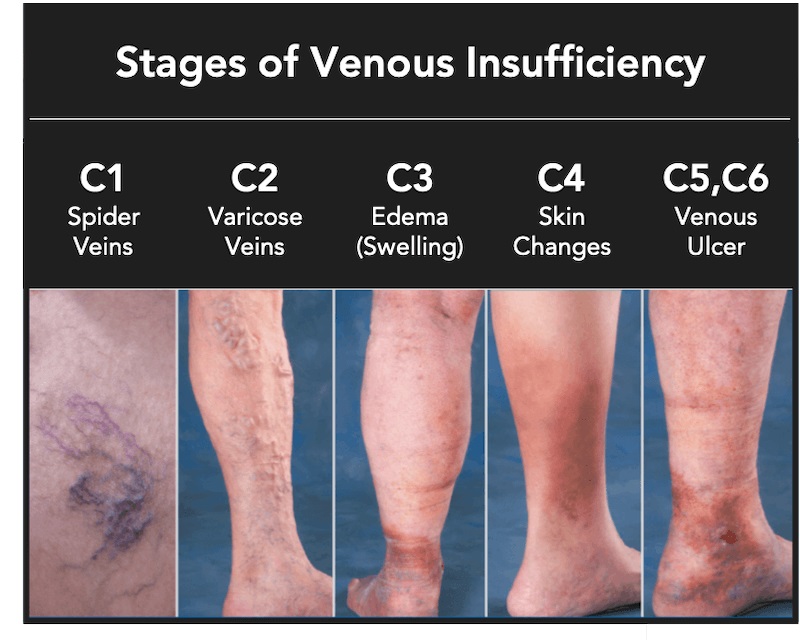 Diagram showing the six clinical stages of chronic venous insufficiency, ranging from spider veins and varicose veins to skin changes and active leg ulcers.