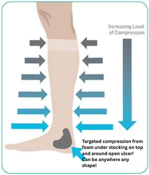 Step 3: The Final Wrap. An elastic bandage is applied to secure the Sladen-Reid foam, creating the necessary tension to activate the vascular pump during movement.